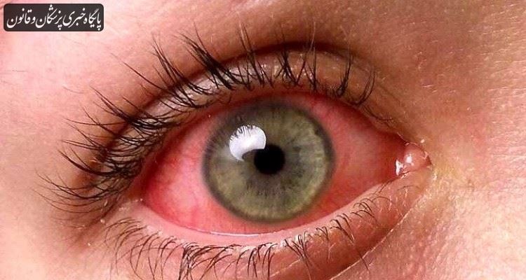شیوع عفونت‌های ویروسی چشمی در فصل سرما