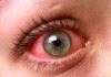شیوع عفونت‌های ویروسی چشمی در فصل سرما