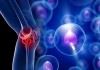 نقش سلول‌های بنیادی در درمان آرتروز