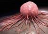 تشخیص زودهنگام سرطان مثانه تا ۱۰ سال قبل از بروز علائم