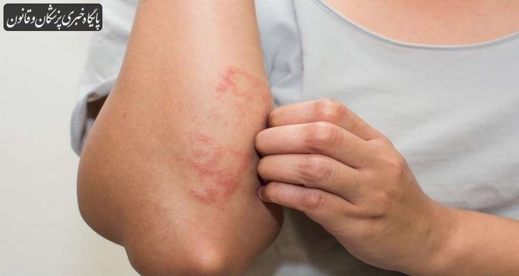 عارضههای پوستی در بین مبتلایان به کرونا شیوع زیادی ندارد عارضههای پوستی در بین مبتلایان به کرونا شیوع زیادی ندارد