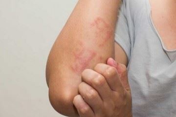 علائم پوستی ویروس کرونا را جدی بگیرید