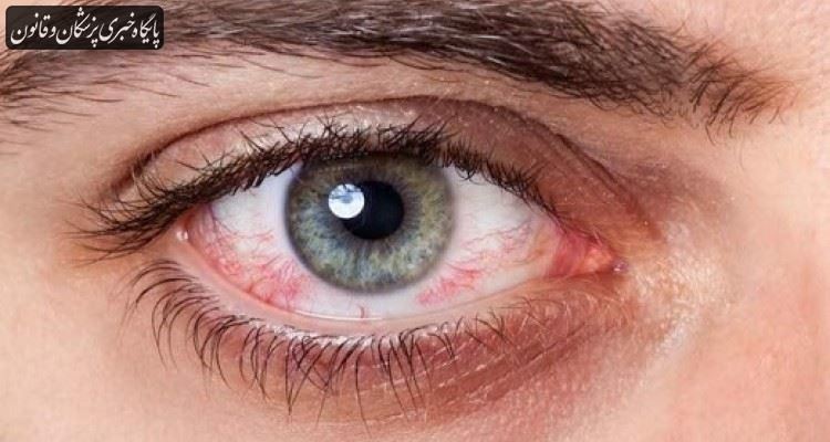 قرمزی چشم از علایم جدید بیماری کرونا است قرمزی چشم از علایم جدید بیماری کرونا است
