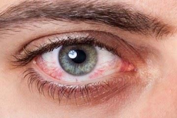 قرمزی چشم از علایم جدید بیماری کرونا است