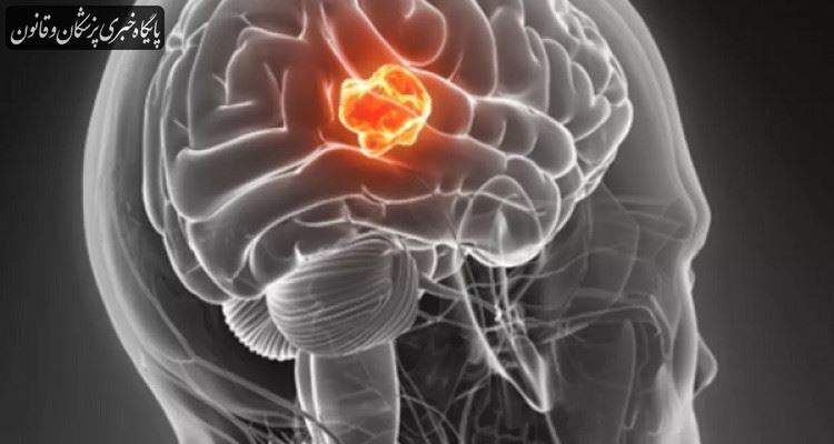 علائم هشدار دهنده تومور مغزی را بشناسید