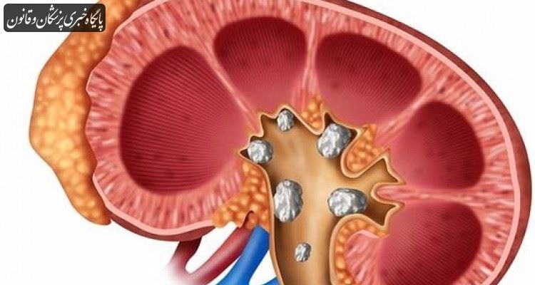 ایران بالاترین میزان شیوع سنگ ادراری را دارد