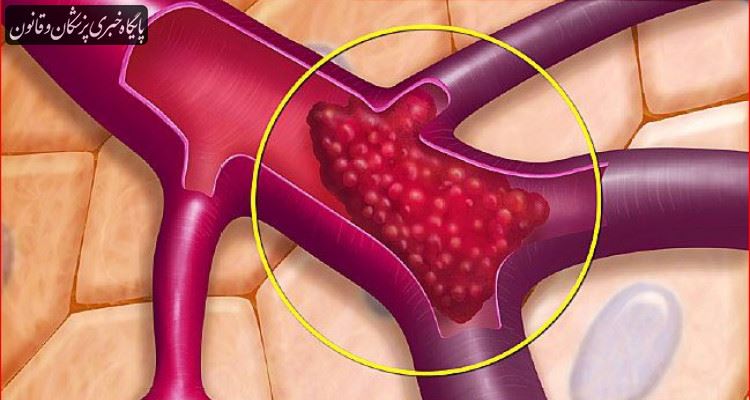 تولید جدیدترین داروی ضد لخته جهت درمان بیماران سکته مغزی