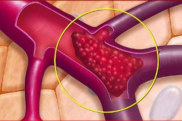 تولید جدیدترین داروی ضد لخته جهت درمان بیماران سکته مغزی
