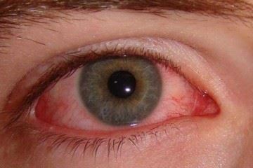 معاینه تغییرات حاد در چشم‌ها را به دلیل بیماری کرونا به تعویق نیاندازید