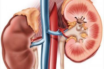 راهکار طب سنتی برای درمان سنگ کلیه