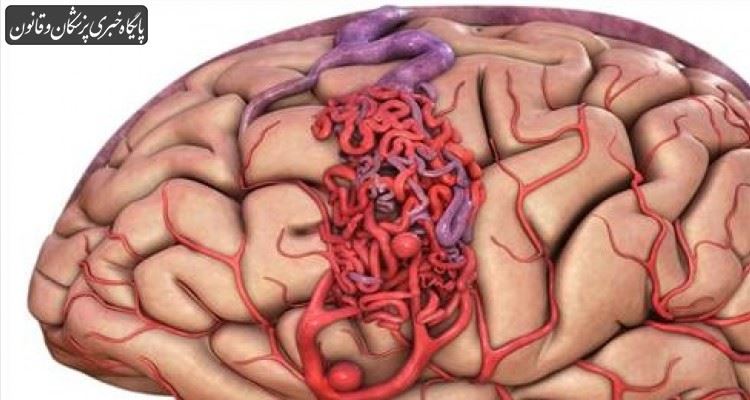 عوامل ایجاد کننده آنوریسم مغزی چیست؟