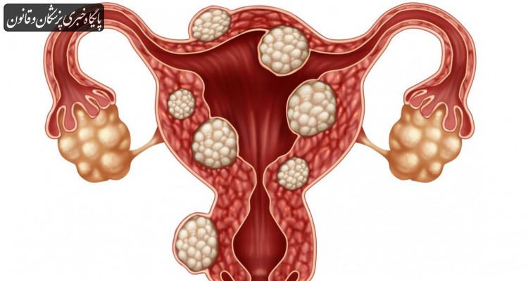 آنچه در مورد فیبروئید‌های رحمی باید بدانید