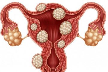 آنچه در مورد فیبروئید‌های رحمی باید بدانید