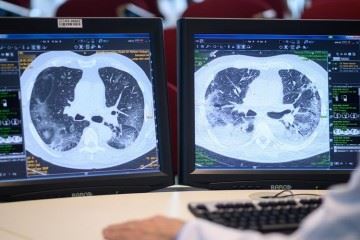 افزایش ۲۵۰ درصدی سی‌تی‌اسکن ریه در بیمارستان‌های دانشگاه‌های علوم پزشکی