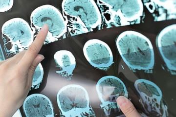 ابداع روش نوین درمان تومورهای لاعلاج مغزی