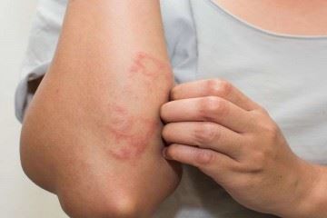 کهیر، جوش و ریزش مو از عوارض ابتلا به بیماری کروناست