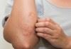 کهیر، جوش و ریزش مو از عوارض ابتلا به بیماری کروناست