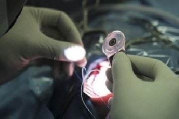 بیش از ۱۴ هزار نفر از طریق کاشت حلزون شنوا شدند