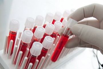 بررسی تاثیر گروه خونی افراد در خطر ابتلا به بیماری کووید-۱۹