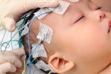 تاثیر انسولین بالا در نوزادان بر آسیب مغزی و معلولیت در طول زندگی