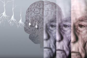 بیش از ۵۵ میلیون نفر در سراسر جهان با زوال عقل زندگی می کنند