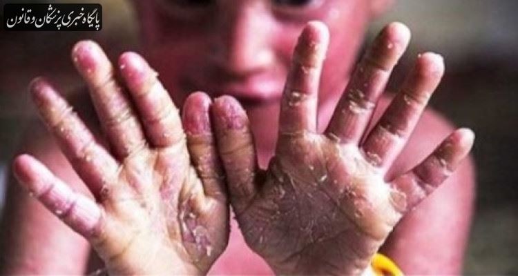 مفقود شدن بخشی از محموله اهدایی پانسمان بیماران پروانه ای صحت ندارد
