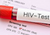 نباید اجازه دهیم که کووید ۱۹ برنامه HIV را تحت تاثیر قرار دهد