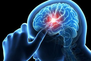 سکته‌های مغزی یکی از شایع‌ترین مشکلات پزشکی است