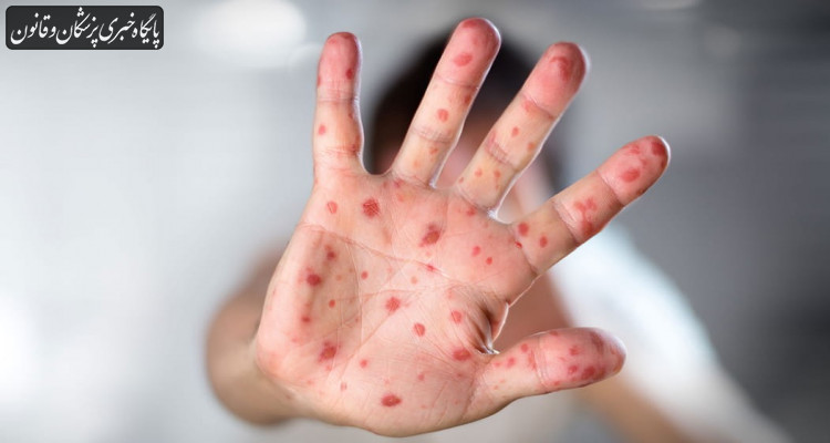 شدت مسری بودن بیماری سرخک بسیار بالاست