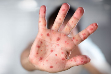 شدت مسری بودن بیماری سرخک بسیار بالاست