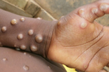 "آبله میمونی" همه‌گیر می‌شود؟