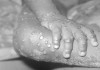 آبله میمونی چیست و چه گونه‌هایی را مبتلا می‌کند؟