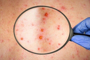 کدام افراد به آبله میمون مبتلا می‌شوند؟