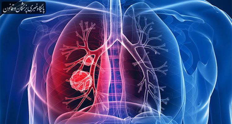 هوای آلوده و سمی عامل افزایش ابتلا به سرطان ریه در افراد غیر سیگاری