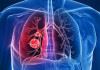 هوای آلوده و سمی عامل افزایش ابتلا به سرطان ریه در افراد غیر سیگاری