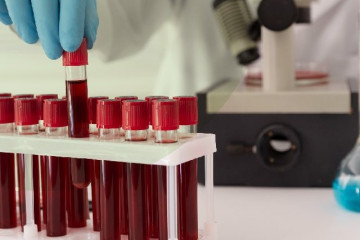 پیگیری ثبت ۲ میلیون داوطلب اهداکننده سلول‌های بنیادی خونساز