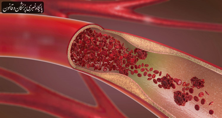 دستیابی محققان ایرانی به روش درمان جدید بیماری تصلب شرائین