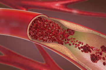 دستیابی محققان ایرانی به روش درمان جدید بیماری تصلب شرائین