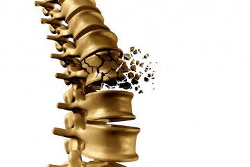 ابتلای ۳۲ درصد جامعه بالای ۵۰ سال ایرانی به پوکی استخوان