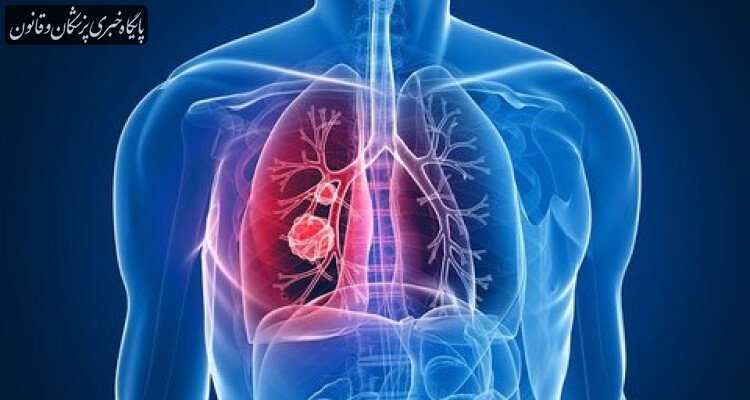 افزایش موارد ابتلا به "بیماری مزمن انسدادی ریه" در جهان تا ۲۰۵۰