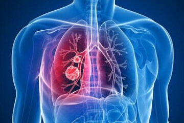 افزایش موارد ابتلا به "بیماری مزمن انسدادی ریه" در جهان تا ۲۰۵۰