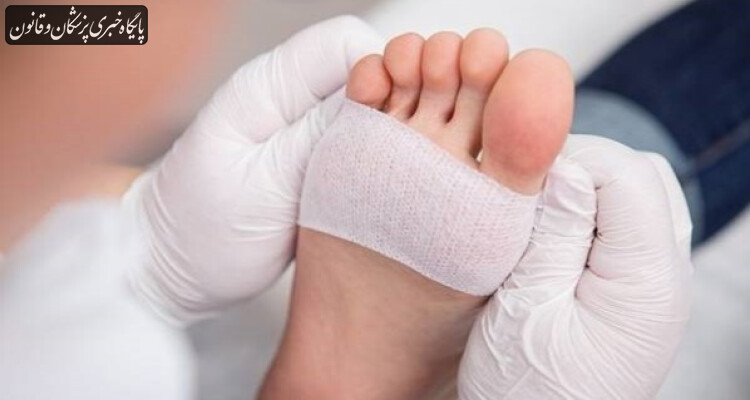 ضرورت جلوگیری از زخم پای دیابتی