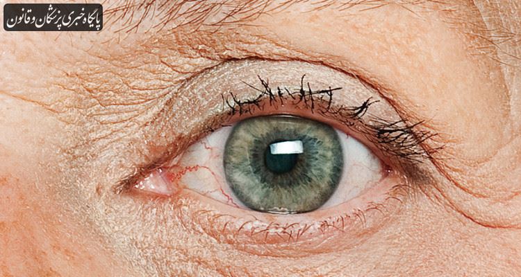 پارکینسون خود را در چشم‌ها و قدرت بینایی بیمار نشان می‌دهد