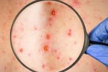 ابتلای کودک دو ساله به بیماری مسری سرخک