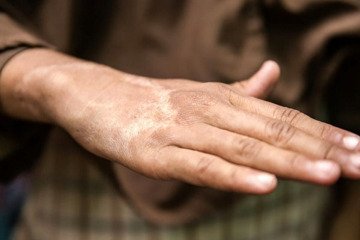 شیوع بیماری جذام در کشور صحت ندارد