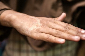 ارائه خدمات تشخیصی و درمانی رایگان جذام در شبکه بهداشت