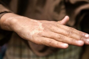 آخرین واکنش‌ها به بیماری جذام در ایران