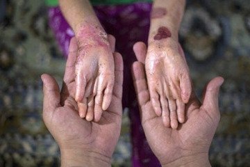 بیش از ۳۰۰ میلیون نفر در سراسر جهان با بیماری‌های نادر زندگی می‌کنند