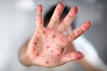 رکورد جدید شیوع سرخک در «تگزاس»