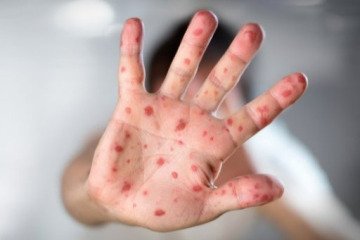 شیوع سرخک در جاسک هرمزگان، واکسن موجود است